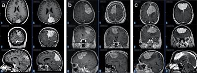 DNA Methylation Associates With Clinical Courses of Atypical Meningiomas: A Matched Case–Control Study